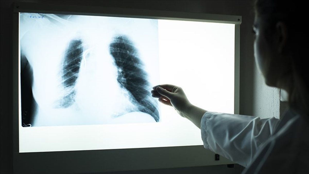 Akciğer kanseri vakalarının yüzde 95’inden sigara sorumlu